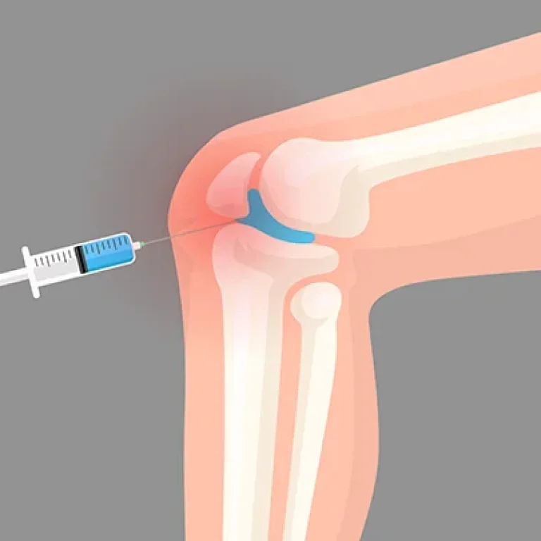 infiltracao-articular-alivia-dor